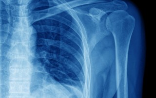pseudoartrosis tratamiento