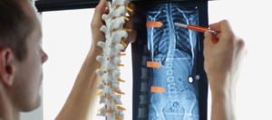 escoliosis