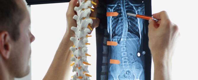 escoliosis
